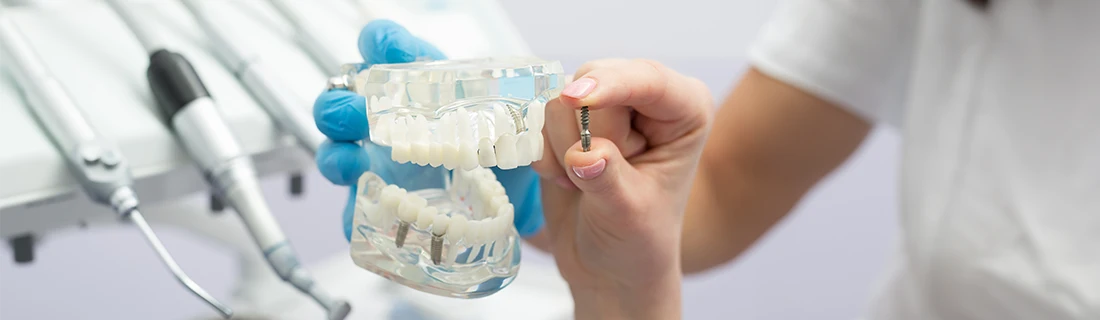 Showing Patient Model Of Dental Implant