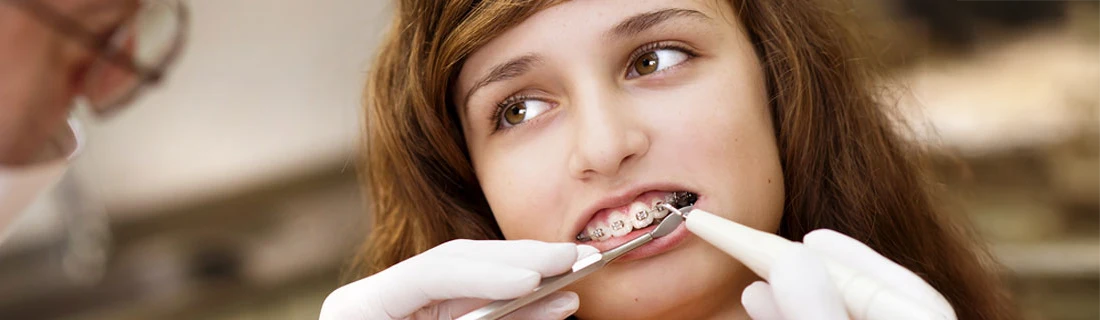 Dentist Cleaning Childs Braces